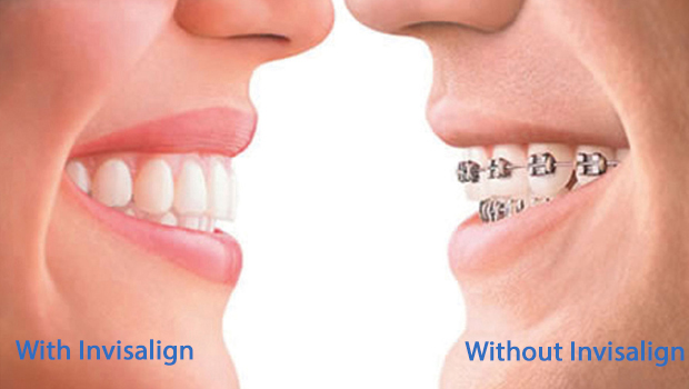 Invisalign in Yonkers