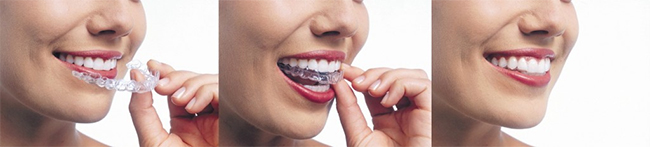 Invisalign Yonkers
