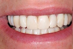 Mt. Vernon Before and After Dental Implants