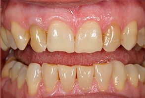 South East Yonkers Before and After Teeth Whitening